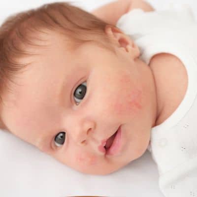 Baby with a face rash